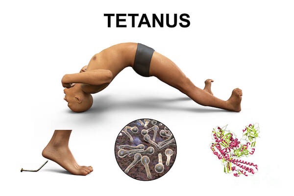 Tetanus